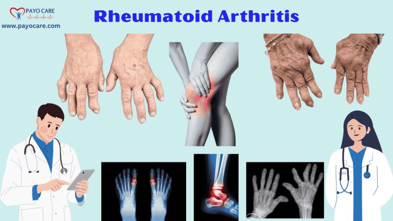 Rheumatoid Arthritis: Causes, Symptoms & Treatment
