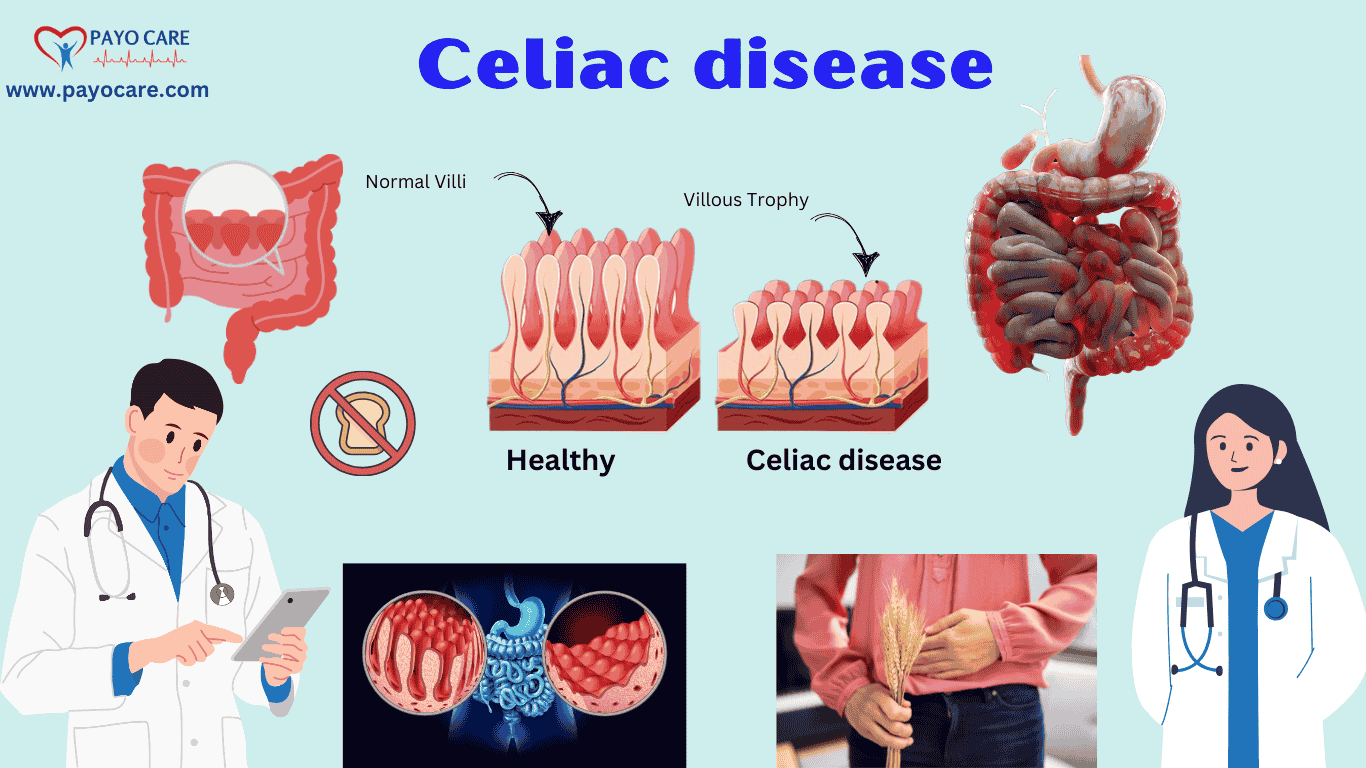 Celiac disease :Causes, Symptoms, Prevention & Treatment
