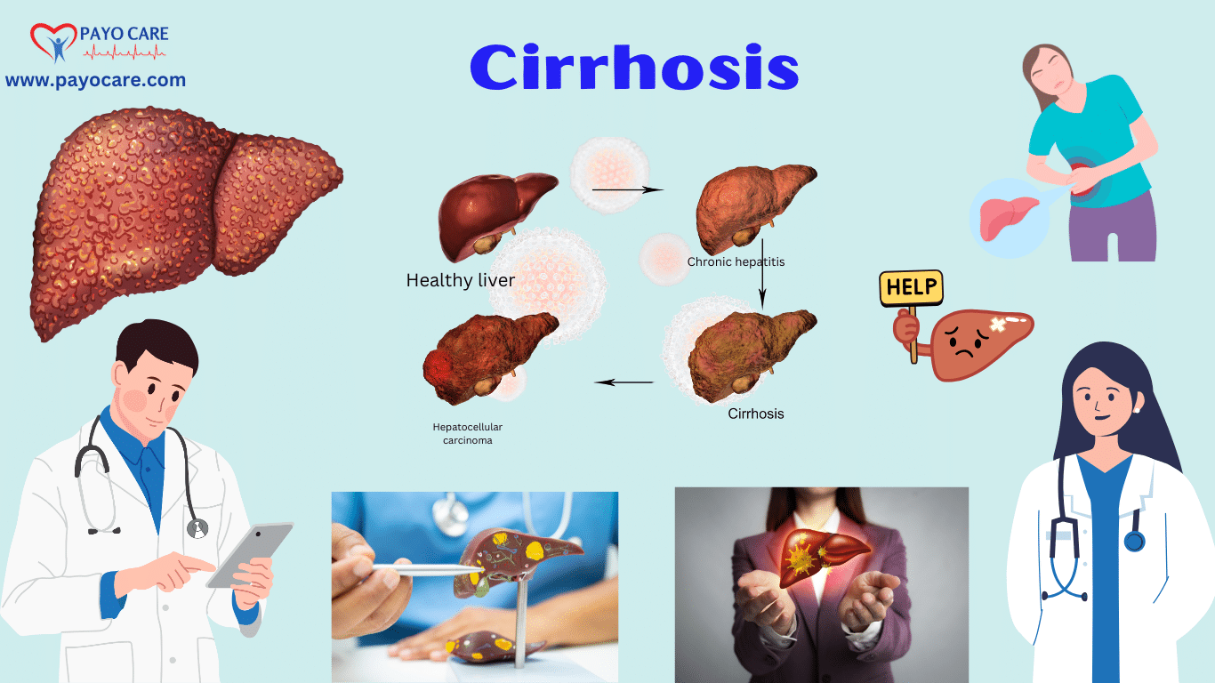 Cirrhosis: Types, Causes, Symptoms & Treatment - Payo Care