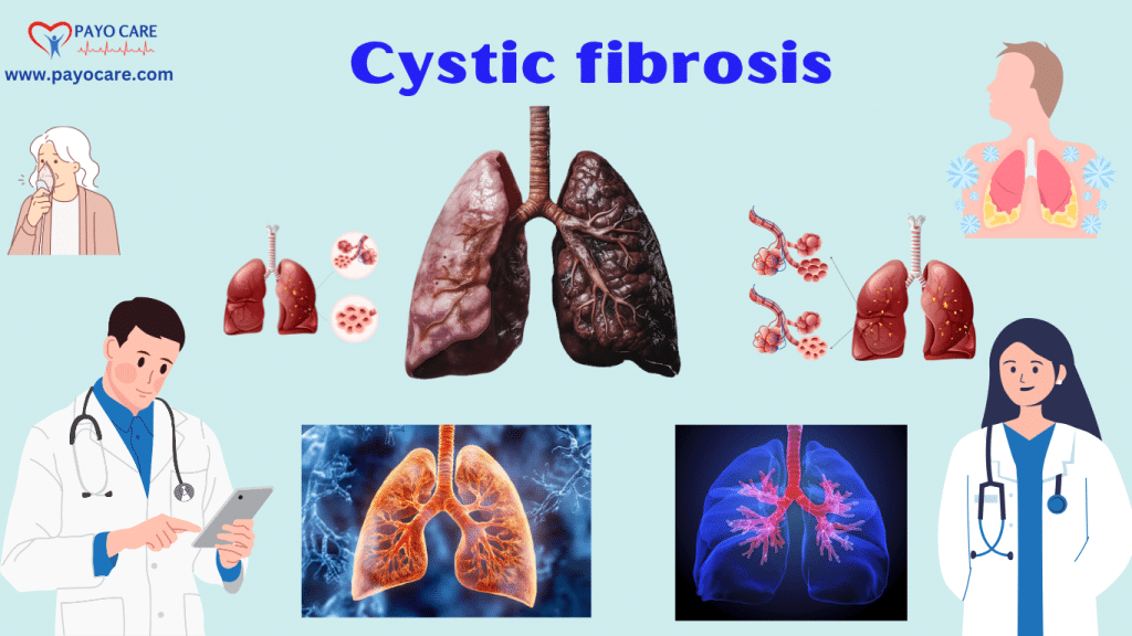 Cystic Fibrosis: Types, Causes, Symptoms, Prevention, Diagnosis & Treatment