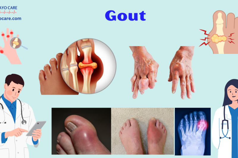 Gout: Causes, Symptoms, Prevention & Treatment