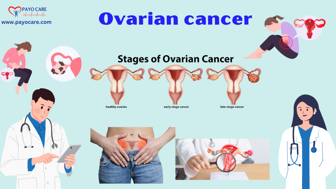 Ovarian Cancer: Causes, Symptoms, Prevention & Treatment