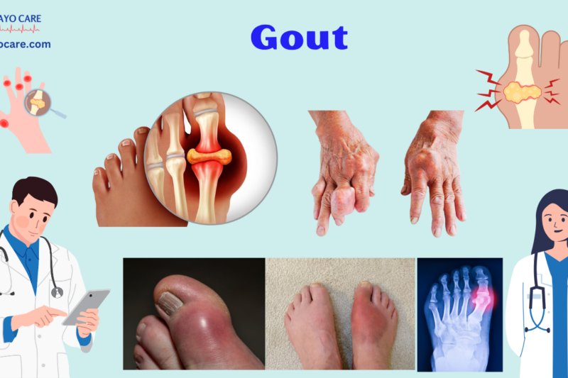 Gout: Causes, Symptoms, Prevention & Treatment