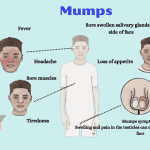 Mumps: Causes, Symptoms, prevention and Treatment