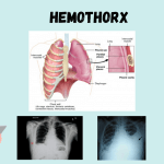 Hemothorax: Types, Causes, Symptoms, Prevention, Diagnosis, and Treatment