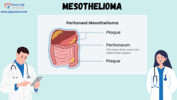 Mesothelioma :Types, Causes, Symptoms, Prevention, Diagnosis, and Treatment