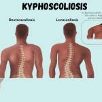 Kyphoscoliosis: Causes, Symptoms, Prevention, Diagnosis, and Treatment