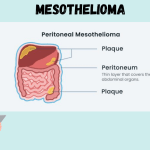 Mesothelioma :Types, Causes, Symptoms, Prevention, Diagnosis, and Treatment